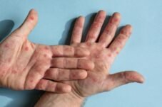 Ramai Australia Dapat Kasus Impor Campak dari RI, Ada Lonjakan? Kemenkes Bilang Gini