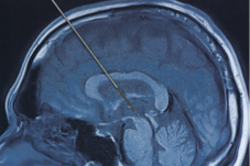 Mengenal Deep Brain Stimulation, Prosedur untuk Bantu Kendalikan Parkinson
