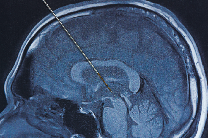 Mengenal Deep Brain Stimulation, Prosedur untuk Bantu Kendalikan Parkinson